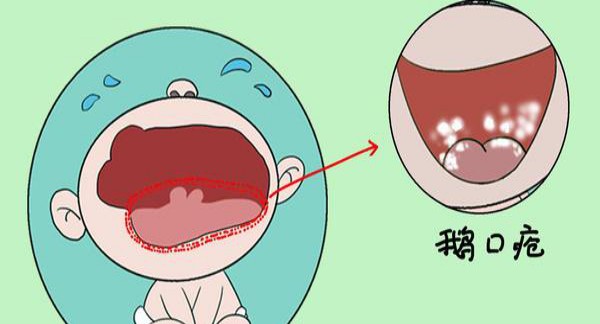 ＂精元抗体＂婴儿积食发烧怎么办_婴儿积食发烧的处理方法